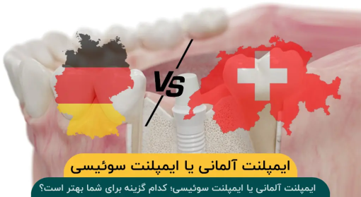 تفاوت-ایمپلنت-آلمانی-ایمپلنت-سوئیسی